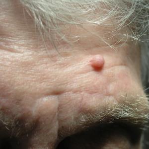 Pigmented Lesions