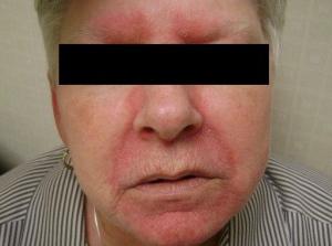 Seborrheic Dermatitis