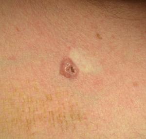 Malignant Lesions