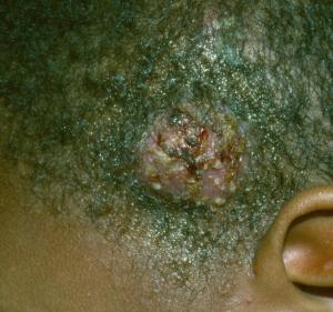 Common Fungal Skin Infections