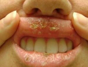 Common Viral Skin Infections