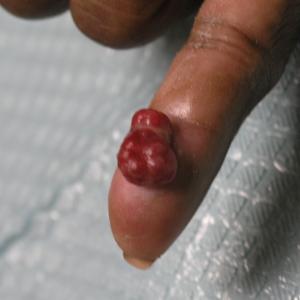 Benign Lesions, Part I