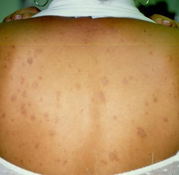 Pityriasis Rosea