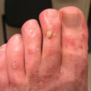 Premalignant Lesions