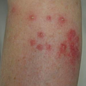 Bites, Stings & Infestations