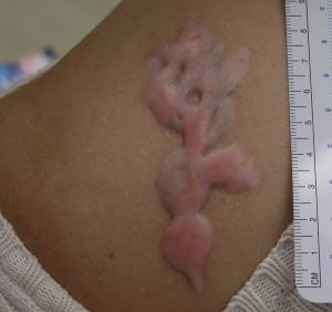 Benign Lesions, Part II