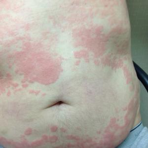 Hives