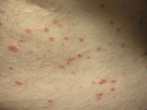 Psoriasis