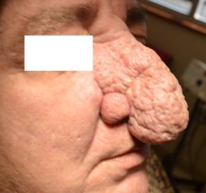 Rosacea